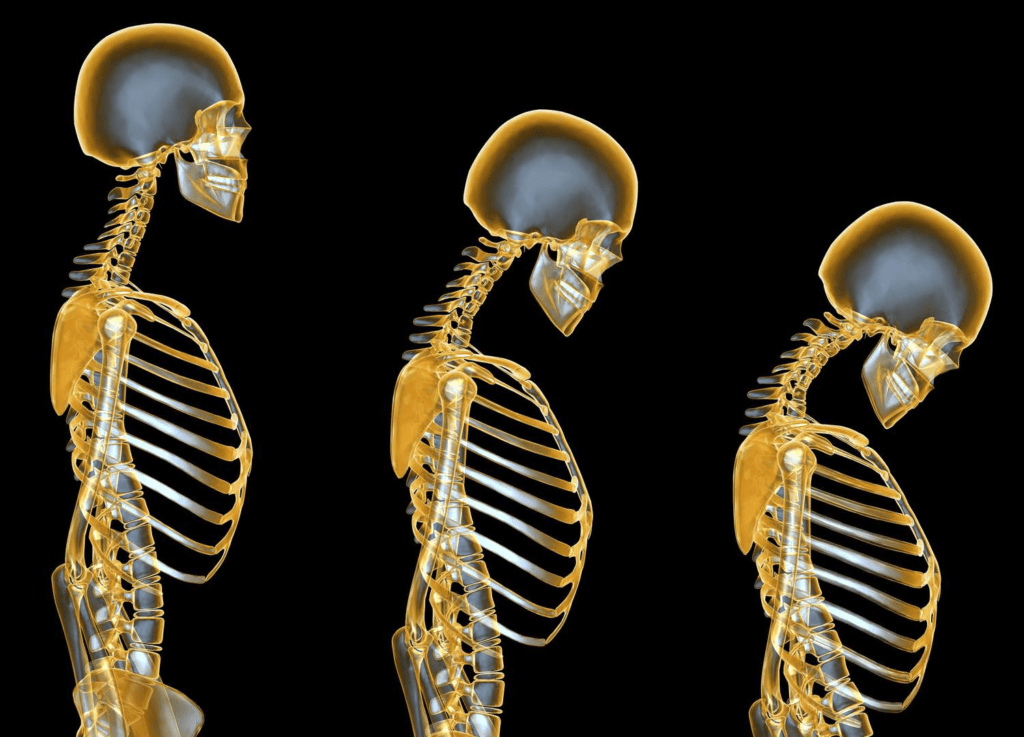 Osteoporosis: 5 ejercicios que evitan su desarrollo y avance - Buena Vida Tips