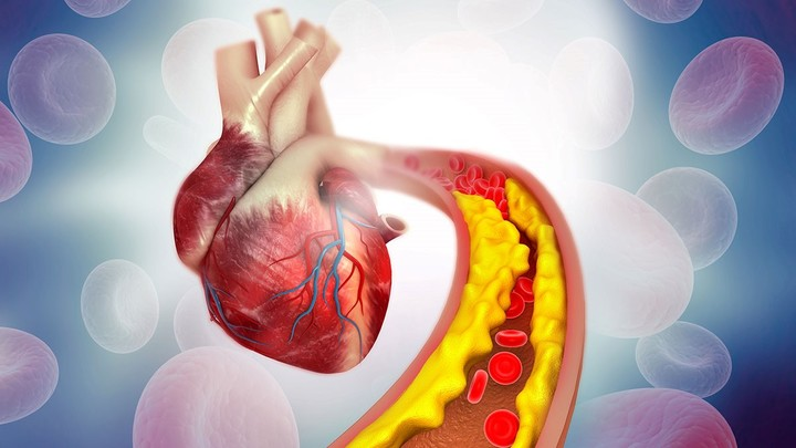 Colesterol alto: los 10 síntomas más comunes - Buena Vida Tips