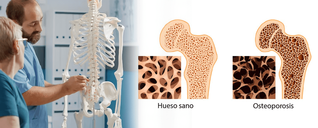 osteoporosis